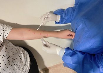 CONFIRMA SALUD ESTATAL UN CASO DE VIRUELA SÍMICA NO GRAVE