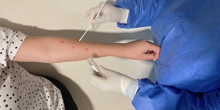 CONFIRMA SALUD ESTATAL UN CASO DE VIRUELA SÍMICA NO GRAVE