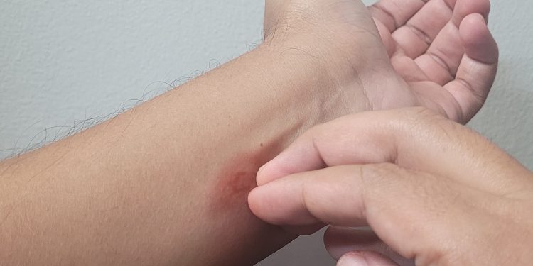 RECOMIENDA IMSS BAJA CALIFORNIA SUR PROTEGERSE CONTRA LA PICADURA DE MOSCO PARA PREVENIR EL DENGUE